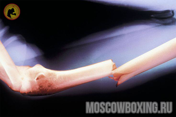Можно ли заниматься боксом после перелома